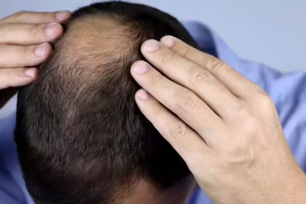 Popular hair loss treatment linked to suicide risk and mental disorders; New studies warns |