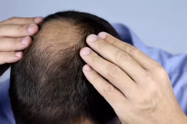 Combat Hair Loss with These Essential Vitamins and Minerals