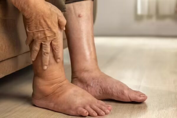 Pancreatic Cancer: 4 Leg Symptoms You Must Not Overlook