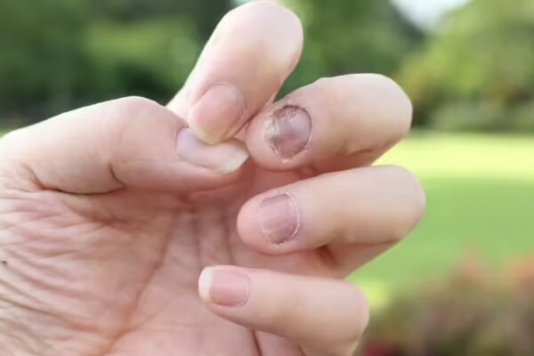 6 Nail Warning Signs You Must Not Overlook: They May Signal Serious Health Issues