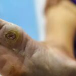 High Blood Sugar Gradually Harms Your Feet: Understanding the Causes, Symptoms, and Science of Diabetic Foot Ulcers